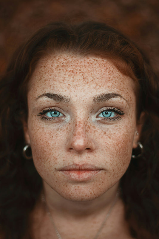 Understanding Hyperpigmentation – Part 2: When Are You Most Vulnerable?