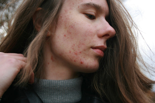 The Beauty Benefits of Phytoncide (Part 3): Caring for Sensitive Skin