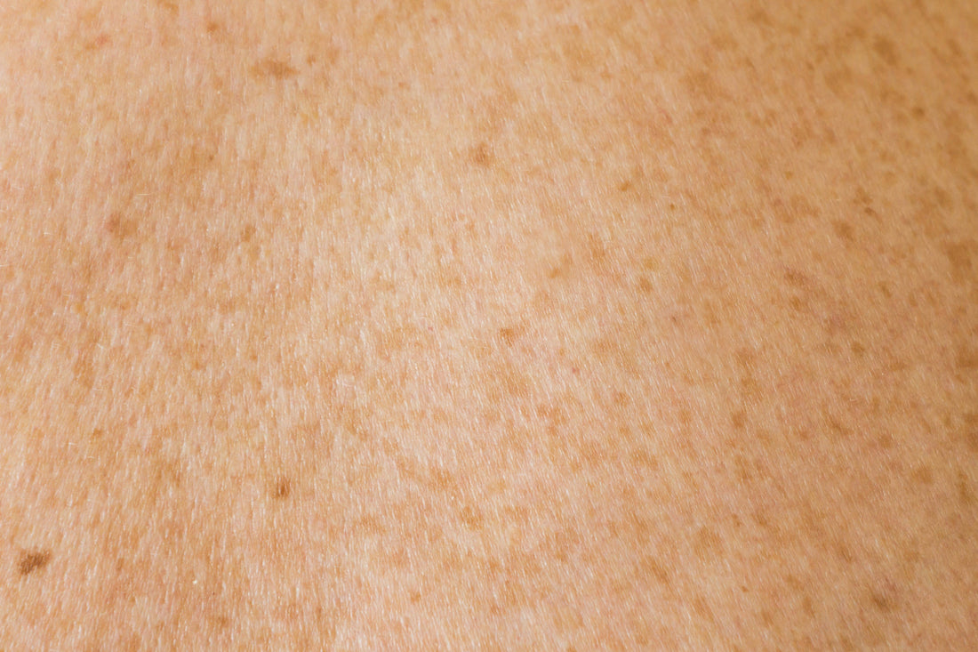 Say No to Blackheads