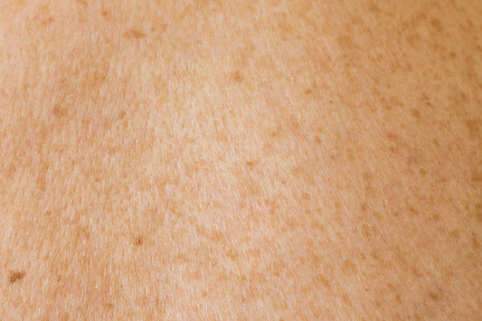 Say No to Blackheads